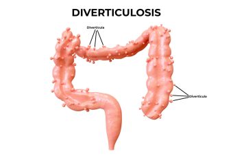 Diverticular Diverticular